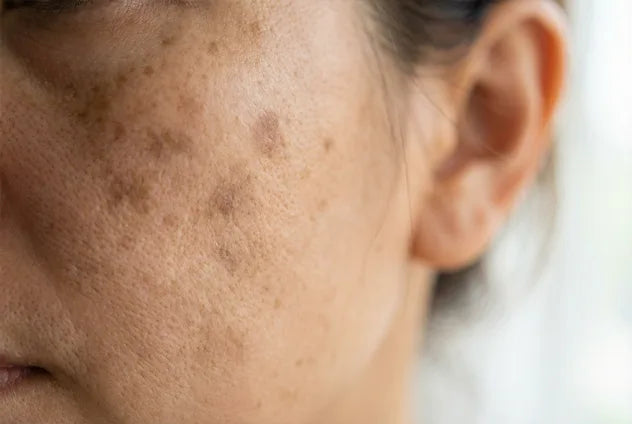 Taches, rougeurs et teint irrégulier